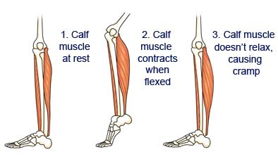 Leg Cramps - Causes and Prevention Tips | PatientsEngage